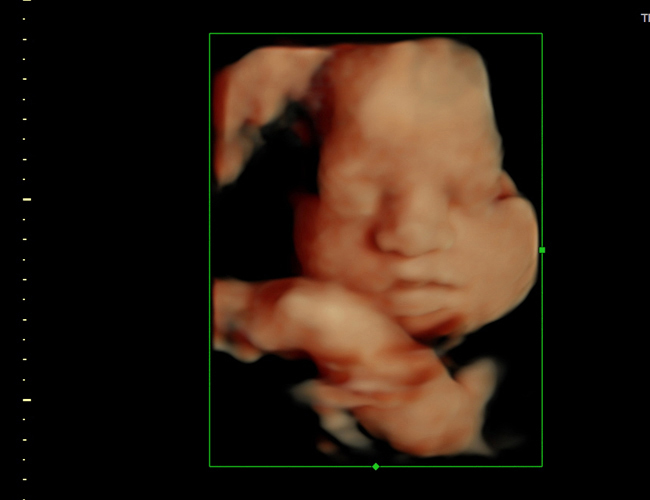 3D ultrasound image at 29 weeks
